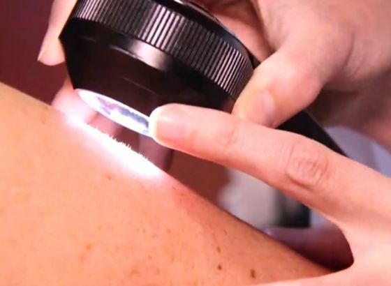 Euromelanoma kampanja "BiH ima problem sa karcinomom kože"