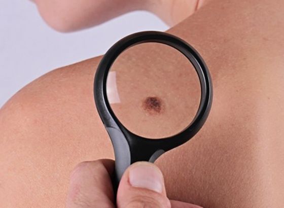 Danas na platou ispred SCC -a: Besplatan pregled mladeža i lezija od 11,00 do 16,00 sati