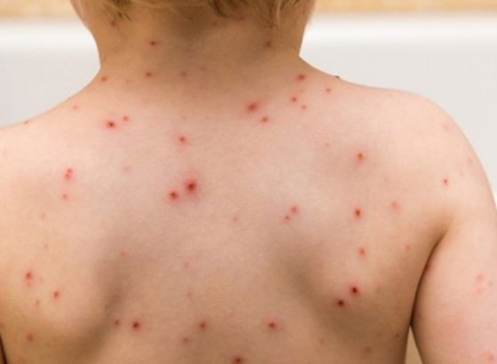 INZ: Važne preporuke i informacije u vezi sa širenjem infekcije morbila