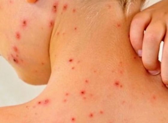 Epidemija morbila u Zvorniku, oboljelo troje djece iz iste porodice