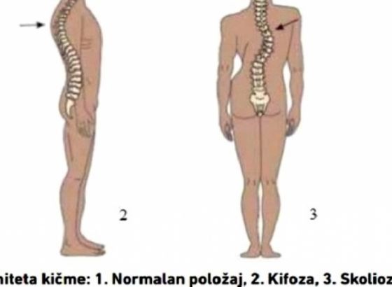 Sve izraženiji deformiteti lokomotornog sistema kod školaraca