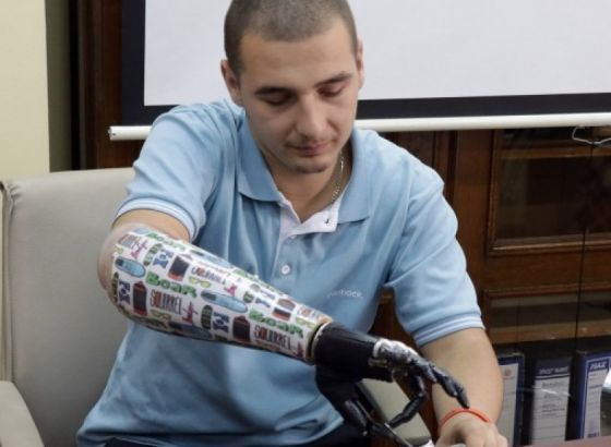 KCUS- Devetnaestogodišnjaku ugrađena proteza ruke kojom upravlja mislima (VIDEO)
