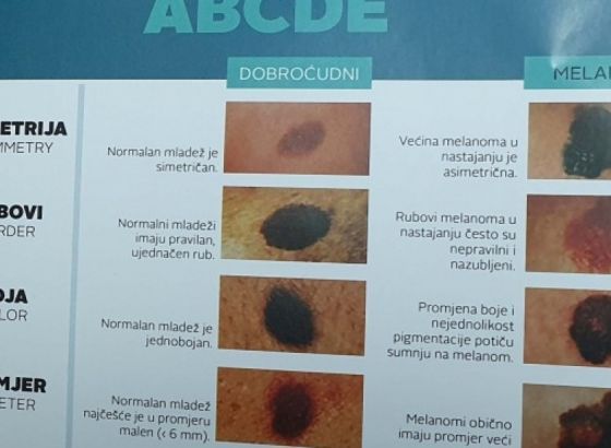 Besplatni pregledi kože u Zenici