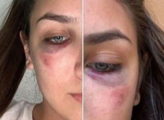 Šokantno: Bh. karatistkinje Ema i Ena Selman brutalno pretučene u svom stanu