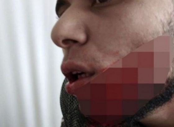 Ogromna posjekotina preko lica: Migrant brutalno porezan nožem u večerašnjoj tučnjavi u garaži 'Mercatora'