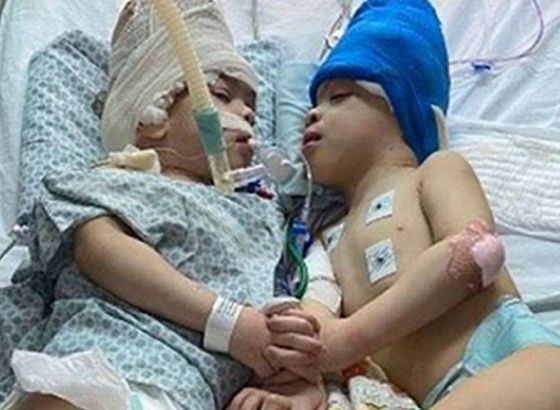 Britanski hirurški tim u Brazilu uspješno razdvojio sijamske blizance spojene mozgovima