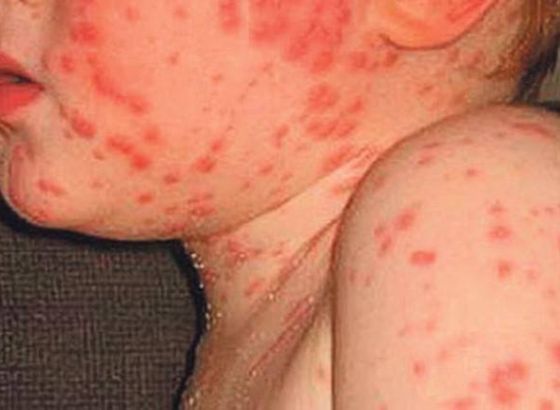 Ukoliko se na poveća procijepljenost, FBiH mogla bi pogoditi epidemija ospica (VIDEO)