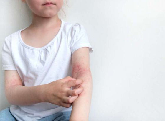 Bečki naučnici otkrili funkcionalnu metodu u terapiji neurodermatitisa