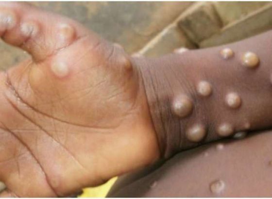 U Pakistanu tri pacijenta s virusom majmunskih boginja