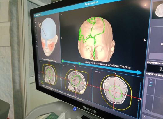 Zenički neurohirurzi obavili i prvu operaciju tumora mozga uz upotrebu uređaja za neuronavigaciju