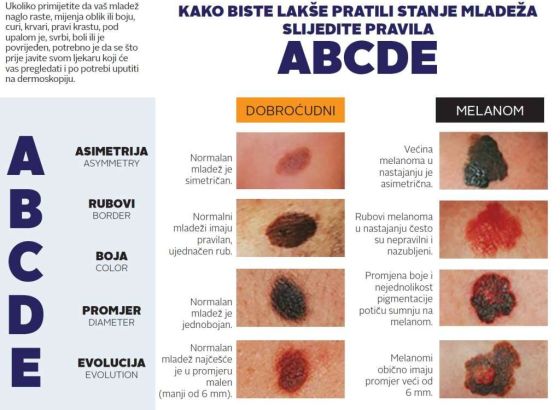 Kako prepoznati melanom, od samopregleda do dijagnoze