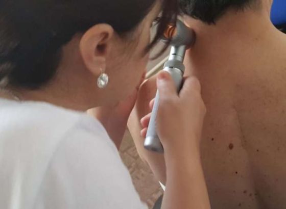Besplatni preventivni pregledi kože u ZDK-u, maj u znaku ranog otkrivanja melanoma